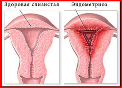 ENDOMETRIOZ